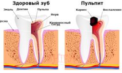 Пульпит молочного зуба