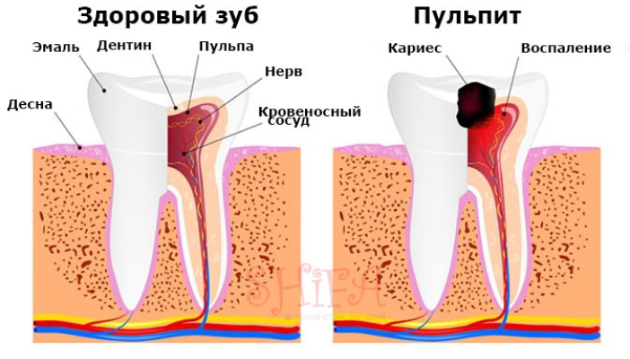 Пульпит молочного зуба