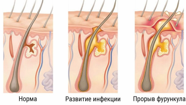 В носу у ребенка фурункул