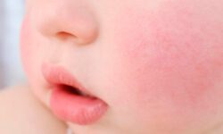 Сыпь на щеках у грудного ребенка