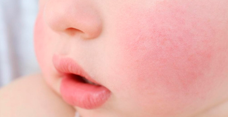 Сыпь на щеках у грудного ребенка